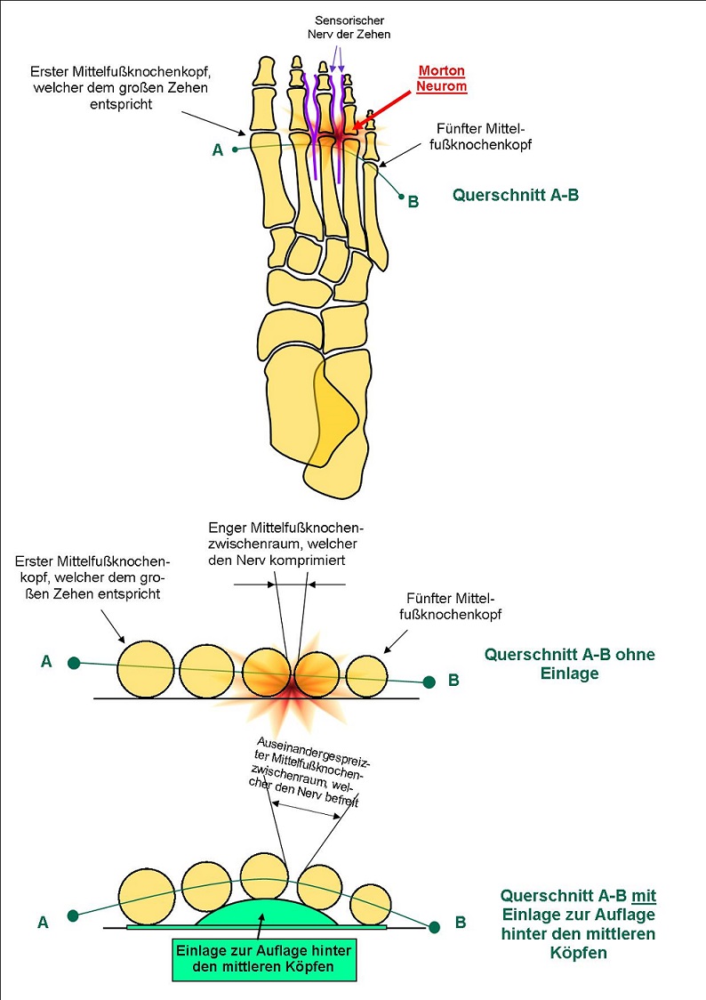 Pathologien > Fußpathologien > Morton-Krankheit oder Morton Neurom
